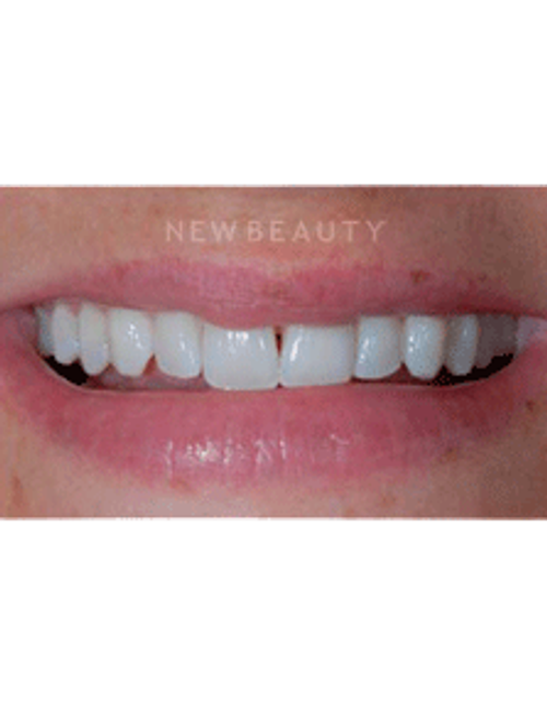 Dr. Guy Lewis Veneers - Before