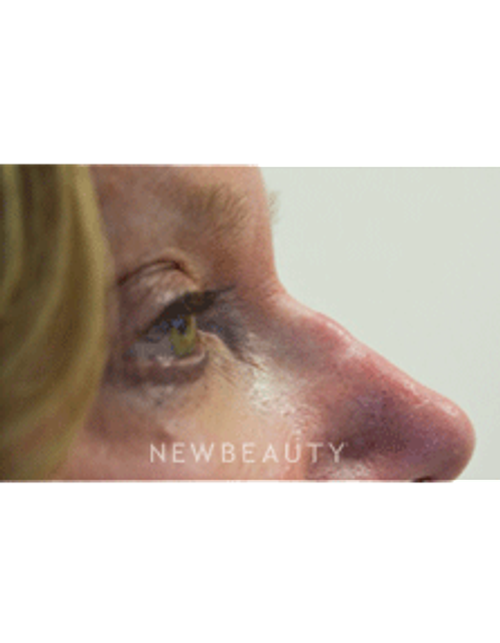 Dr. Julie Russak Non Surgical Rhinoplasty - After