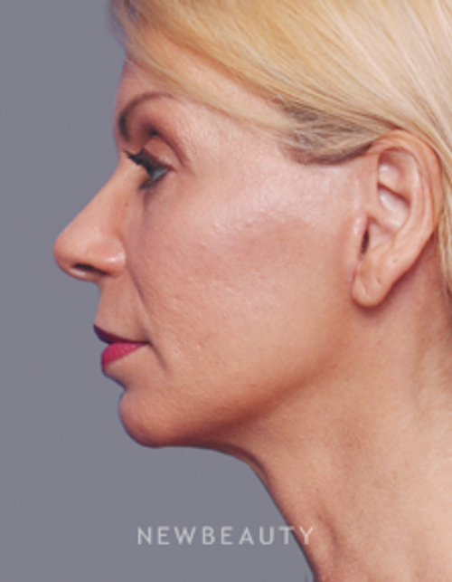 Dr. Alan Durkin Browlift, Blepharoplasty, Facelift, Liposuction - After