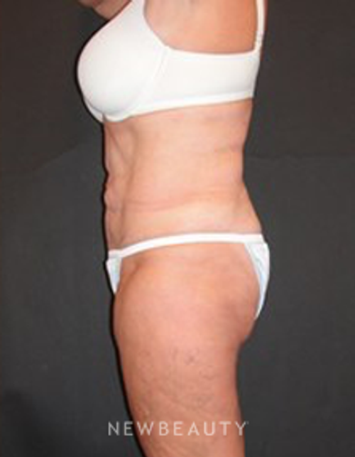 Dr. Joel Schlessinger - SmartLipo - After