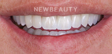 Dr. Husam Almunajed - Smile Makeover - 41358214 - After