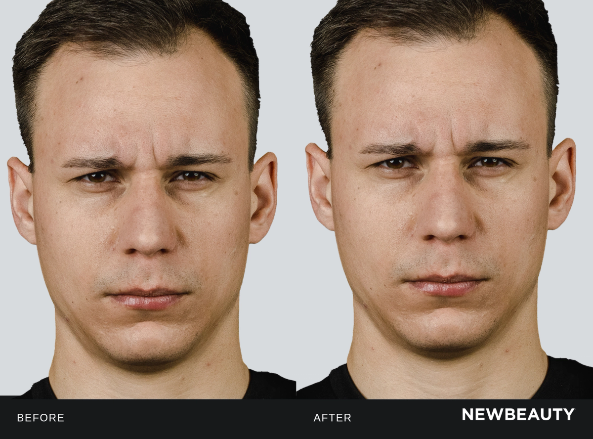Male patient before and four weeks after Letybo treatment for glabellar lines