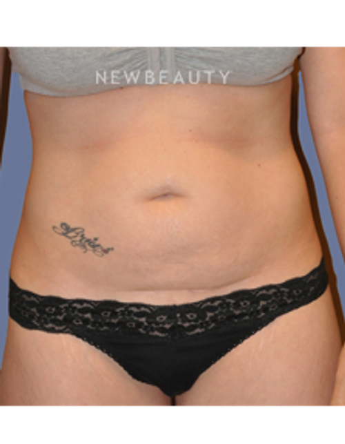 Dr. Bryan W. Gawley - Tummy Tuck - Before