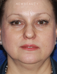 Dr. Konstantin Vasyukevich - Facelift - Before