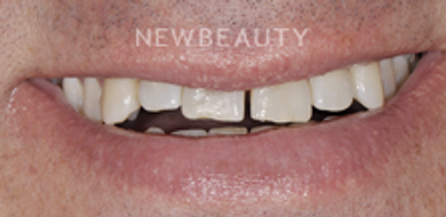 Dr. Salvator La Mastra - Smile Makeover -46107833 - Before