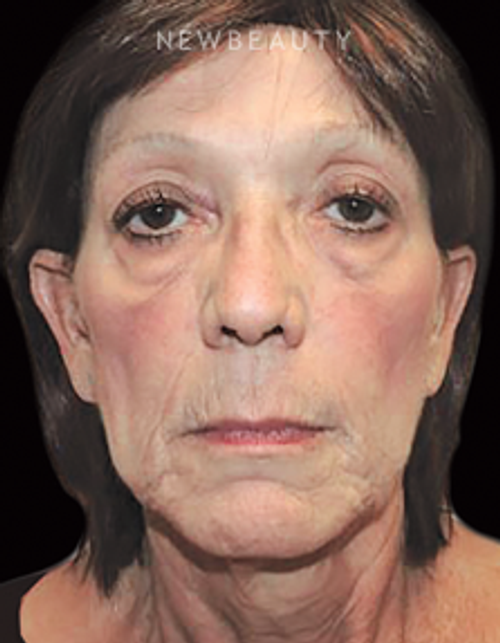 Dr. Joel Schlessinger - A Softer Look - Before