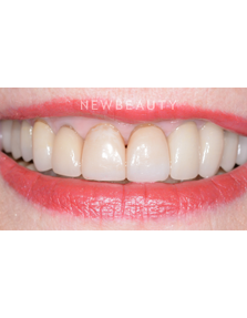 Dr. Guy Lewis - Smile Makeover - Before
