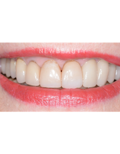 Dr. Guy Lewis - Smile Makeover - Before