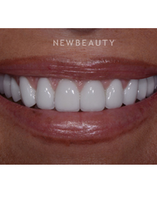 Dr. Guy Lewis - Crowns & Veneers - After