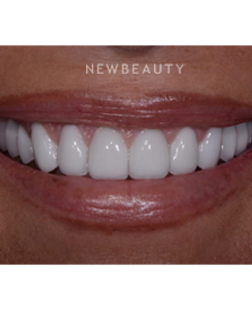 Dr. Guy Lewis - Crowns & Veneers - After