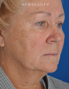 Dr. Edward Kwak - Facelift & Blepharoplasty - Before
