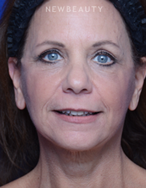 Dr. Alan Durkin - Facelift with Fat Transfer - After