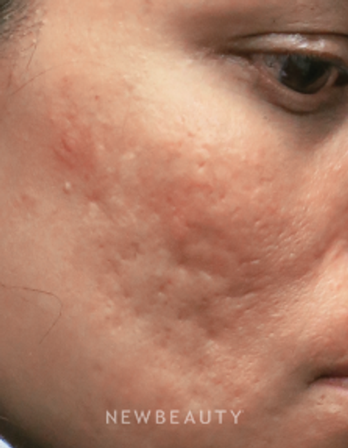 Dr. Jody Levine - Acne Scar Treatment - Before