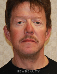 Dr. Dilip D. Madnani - Facelift, Necklift & Eyelift - After