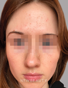 Dr. Anna Chacon - Juvenile Acne - 34284936 - Before