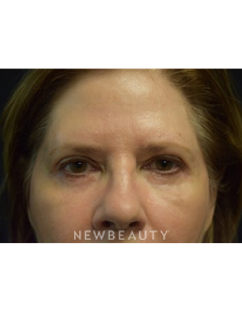 Dr. Jeffrey B. Wise - Blepharoplasty - After