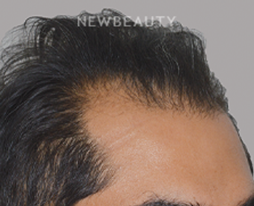Dr. Anthony Bared - Hair Transplant - 46164563 - Before