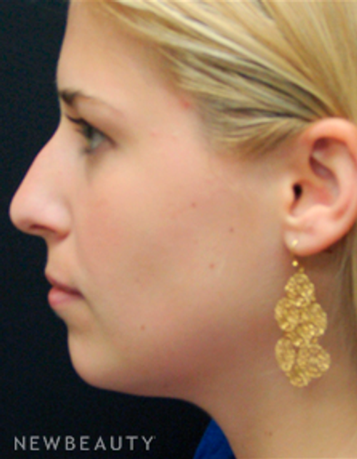 Dr. Mokhtar Asaadi Rhinoplasty - Before