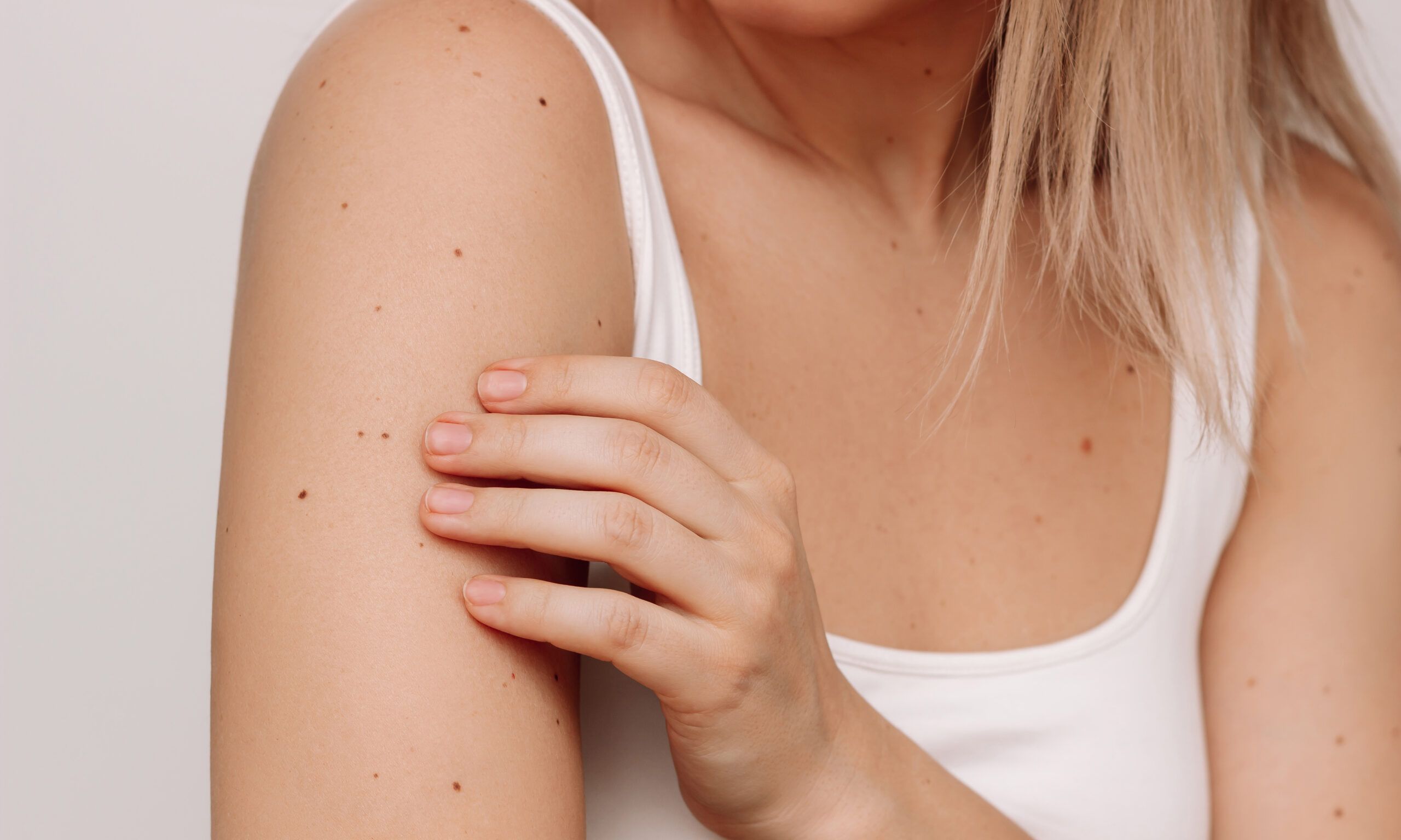 Cropped shot of a young blonde woman with a large number of moles on her arms