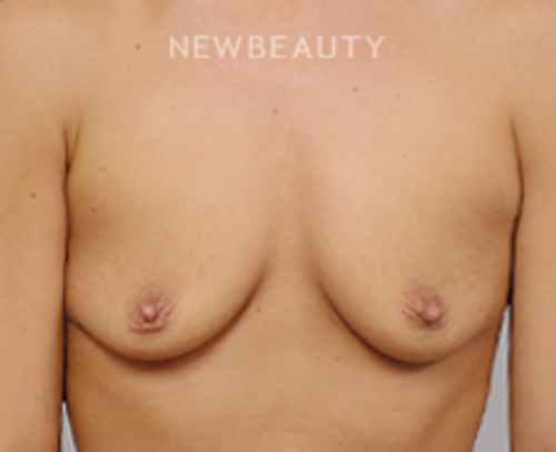 Dr. Jeffrey R. Antimarino - Breast Enhancement - 25108042 - Before