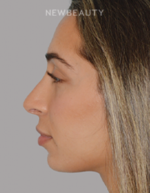 Dr. Anthony Bared - Rhinoplasty - 46164855 - After