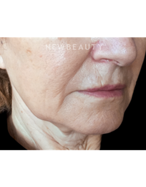 Dr. Kally Papantoniou - Liquid Facelift - Before