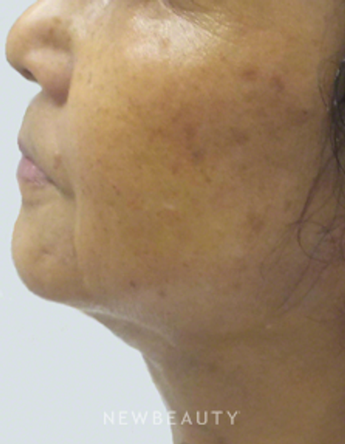 Dr. Kally Papantoniou - Ulthera - Before