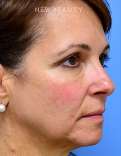 Dr. Mokhtar Asaadi - Browlift - After