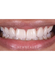 Dr. Husam Almunajed - Smile Makeover - After