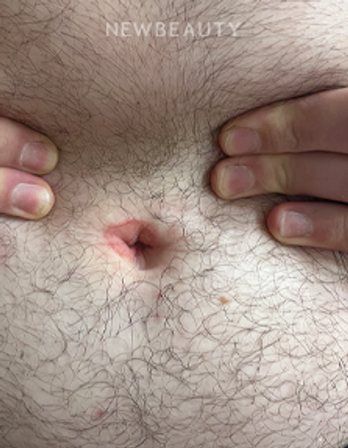 Dr. Anna Chacon -Cellulitis - 34278607 - Before