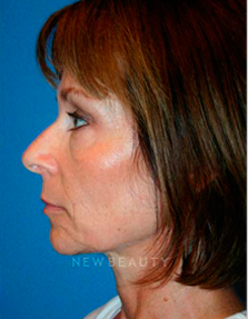 Dr. Kelly Bomer Liquid Facelift - Before