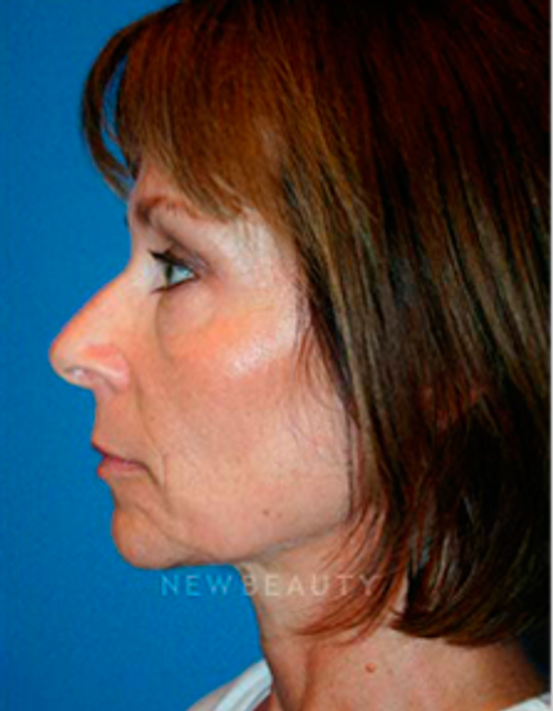 Dr. Kelly Bomer Liquid Facelift - Before