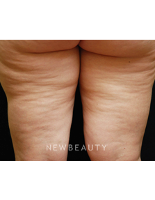 Dr. Kenneth Beer Lasers - Cellulite Treatment - Before