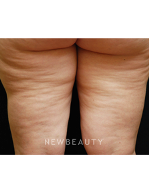 Dr. Kenneth Beer Lasers - Cellulite Treatment - Before
