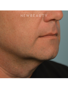 Dr. Ruth Hillelson - Tighter and Firmer - After