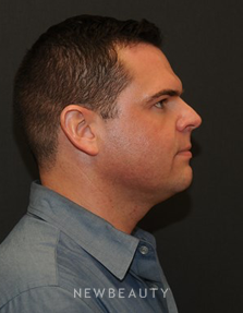 Dr. Janet Allenby - Kybella - Before