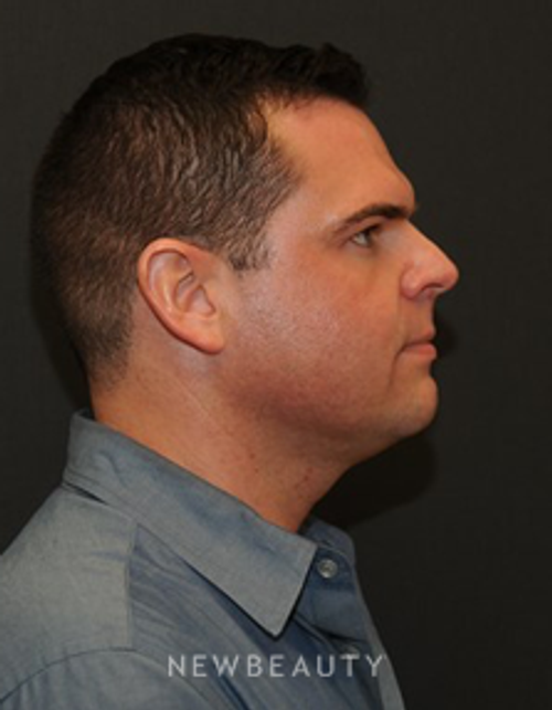 Dr. Janet Allenby - Kybella - Before