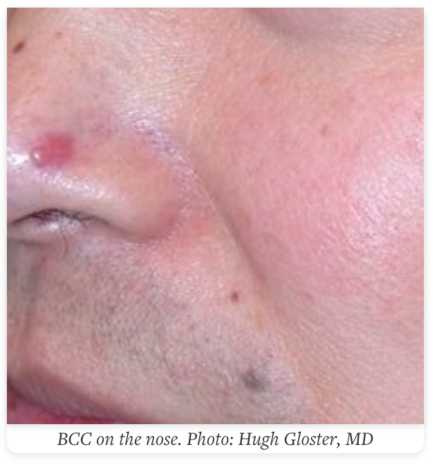 basal cell carcinoma on the nose