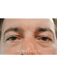 Dr. Lee Ann Klausner Blepharoplasty - Before