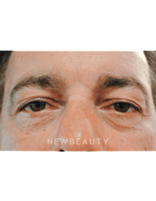 Dr. Lee Ann Klausner Blepharoplasty - Before