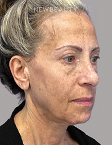 Dr. Dilip Madnani - Facelift -  45284088 - Before