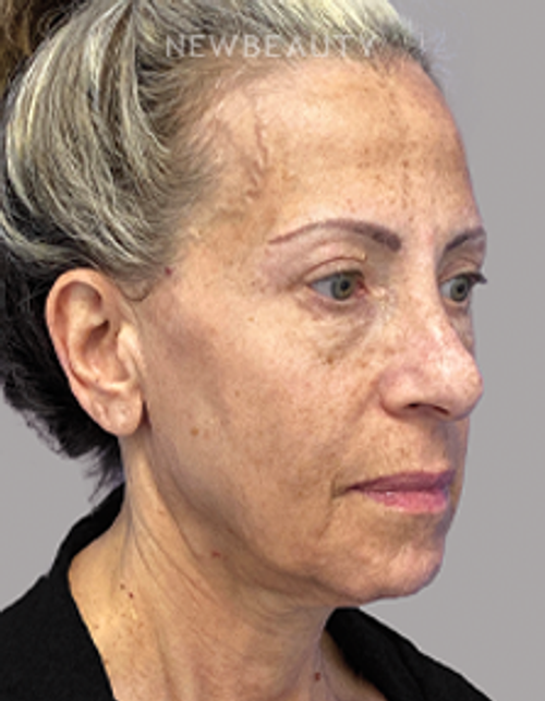 Dr. Dilip Madnani - Facelift -  45284088 - Before