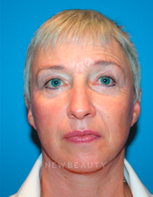 Dr. Kelly Bomer Liquid Facelift - Before