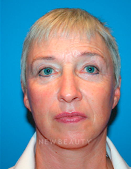 Dr. Kelly Bomer Liquid Facelift - Before