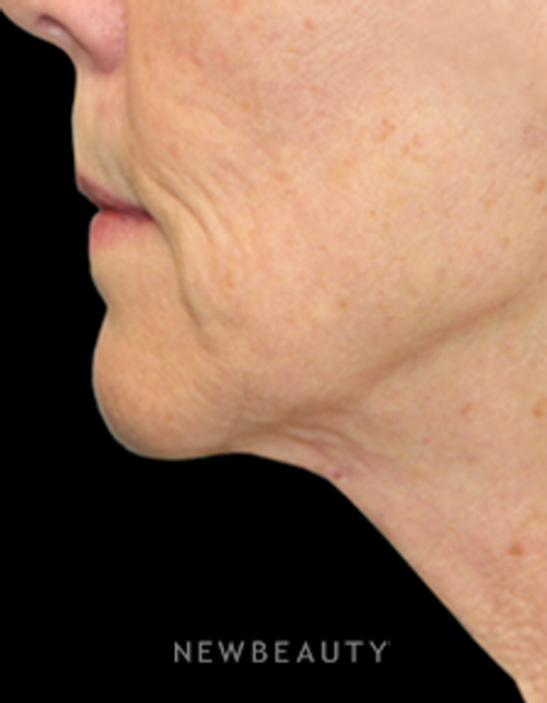 Dr. Christine Hamori - A Subtle, Natural-Looking Lift - Before