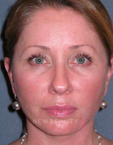 Dr. Min Ahn Facelift, Necklift - After