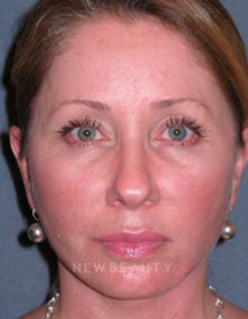 Dr. Min Ahn Facelift, Necklift - After