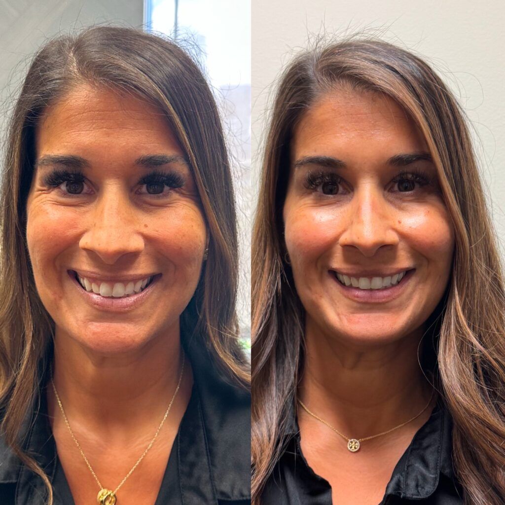 before and after filler