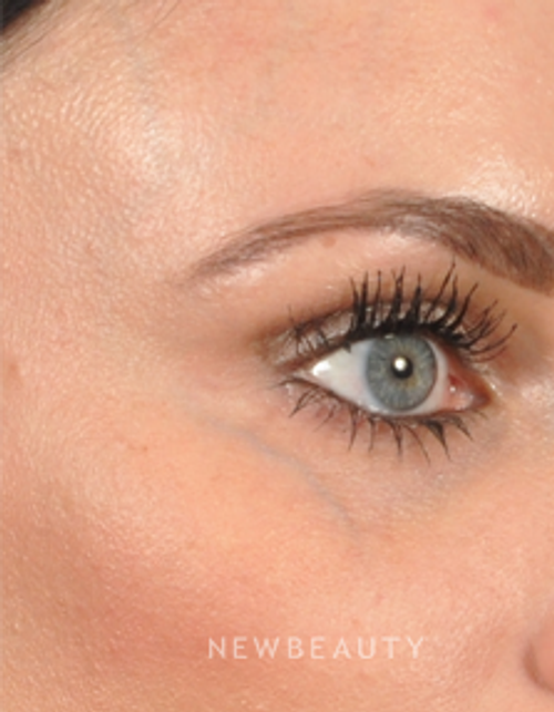 Dr. Bradley Bengtson - Periorbital Vessel Treatment - Before