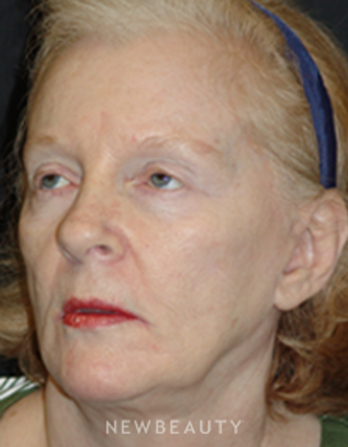 Dr. Mokhtar Asaadi Eyelid Lift, Facelift, Necklift - Before
